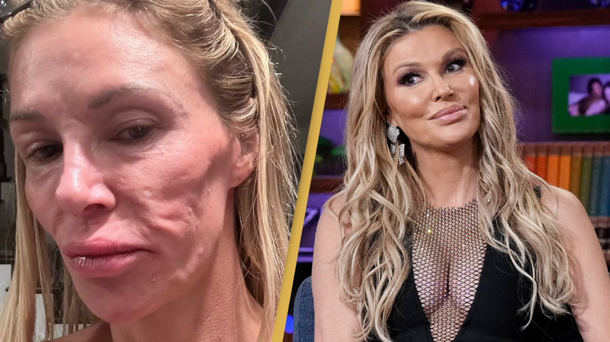 Doctor explains what 'parasite' affecting Brandi Glanville actually is after it causes her to lose five teeth and $70,000