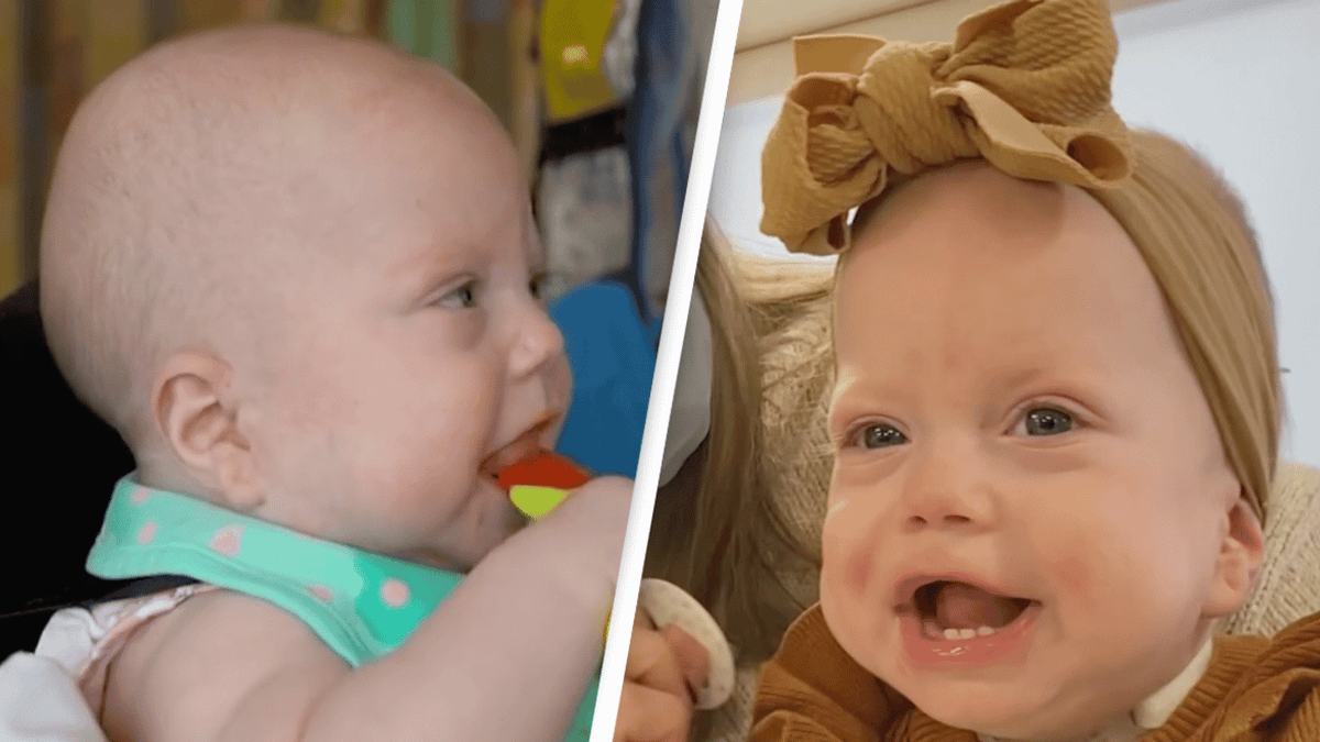 Beckwith Wiedemann Syndrome Tongue Baby Born With Adult Sized Tongue