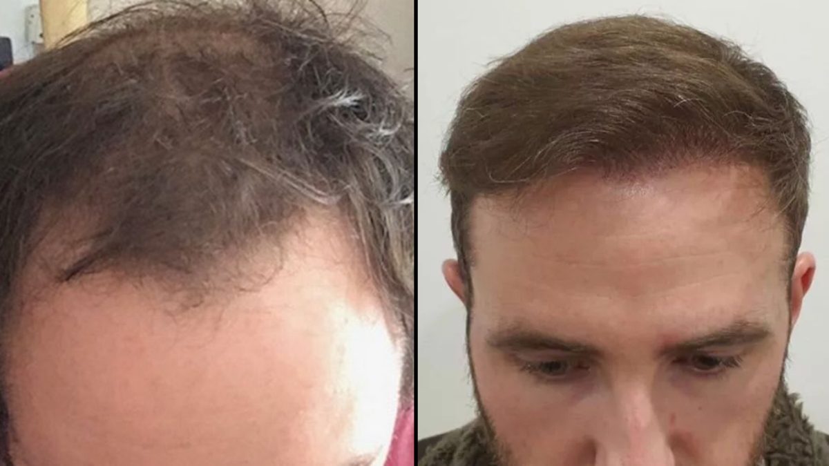 Man left 'abandoned' by clinic after flying to Turkey for £1,300 hair transplant that left him with 'devastating' results