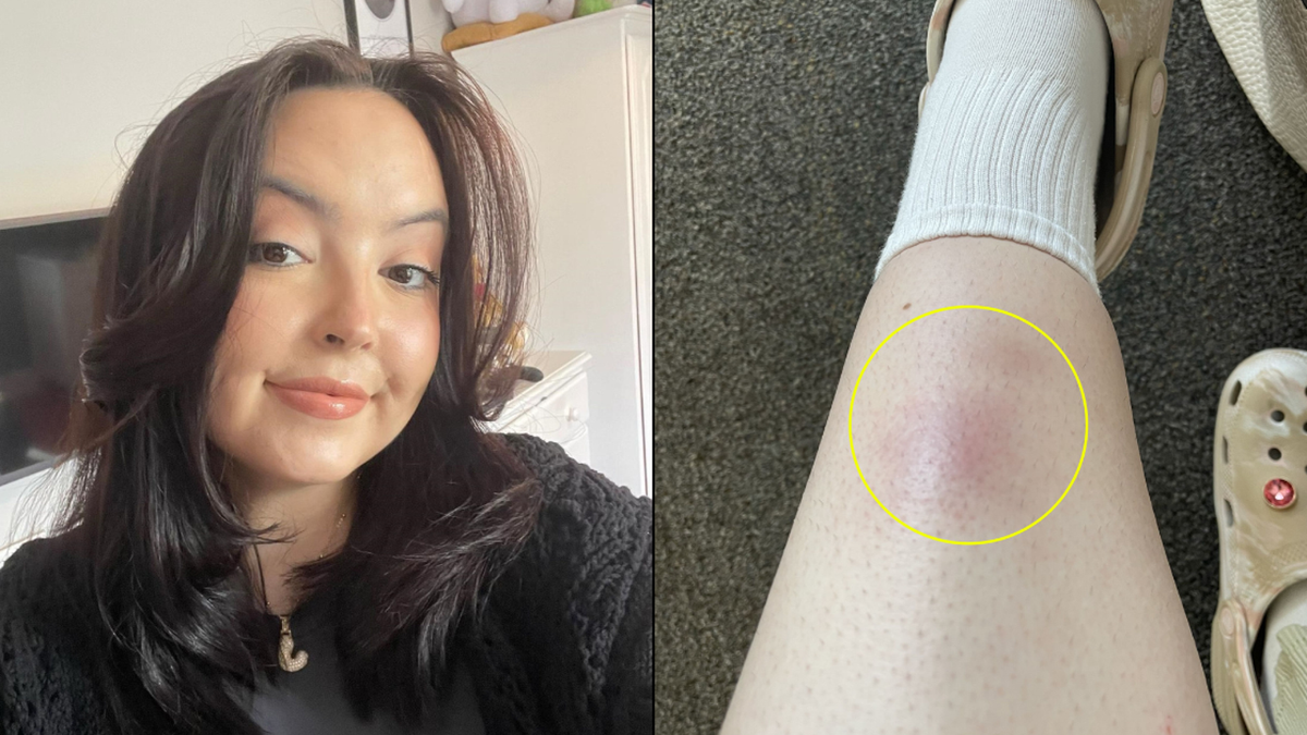 Woman had bizarre cancer warning sign on her leg before being told she ...