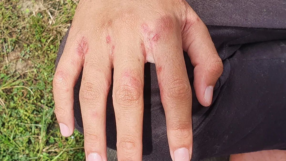 Brits warned as Victorian skin disease that leaves ‘flesh crawling’ surges in UK