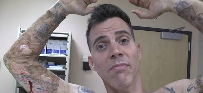 His injuries turned out to be pretty significant. Credit: YouTube/Steve-O