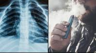 警告因烟雾而引起的新有害肺部疾病评估