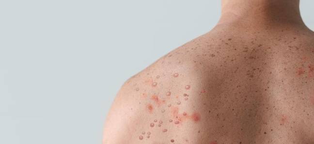 Monkeypox通常会引起独特的皮疹。学分：Jozef Polc/Alamy Stock Photo