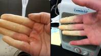 使您的双手变成白色或蓝色时的疾病会影响数百万“loading=