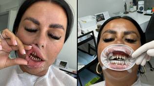 女人说她的4000英镑的“土耳其牙齿”破坏了她的生活