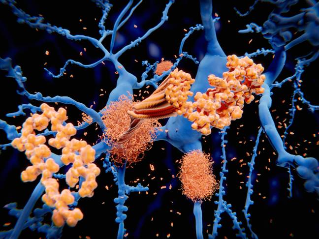 新药铲淀粉样蛋白是一种蛋白质，在阿尔茨海默氏症的人的大脑中积聚。学分：科学图书馆 /阿拉米库存照片
