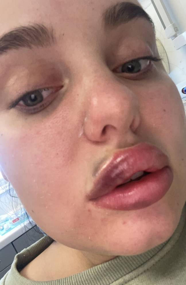 Dental Nurse Almost Blinded By Botched Lip Filler Job