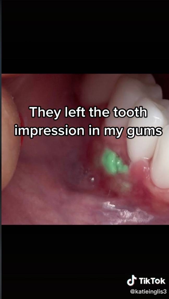 她的牙龈明显地盛满了绿色的油腻的油灰。图片来源： @katieinglis3 / tiktok。