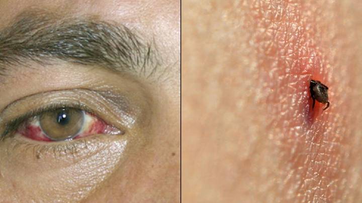 男子患有罕见的眼睛出血病毒，可杀死多达三分之一的患者
