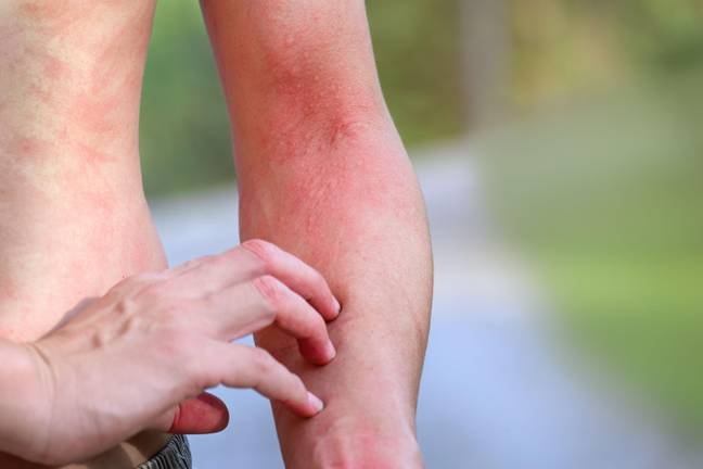 湿疹会引起发痒和片状的皮肤。信用：Alamy