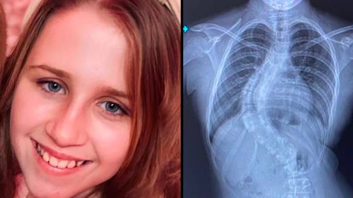 当X射线显示她的脊柱以80度角弯曲时，Girl震惊了