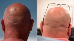 科学家发现了一种潜在的秃头治疗方法