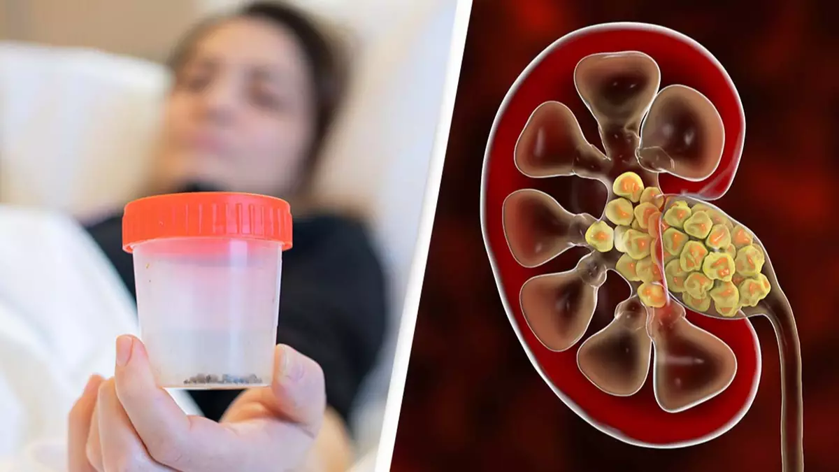 20-year-old woman who prefers trendy drink to water has doctors remove '300 kidney stones'