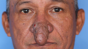 Man With Severe Deformity Gets New Nose After Chance Meeting With Surgeon
