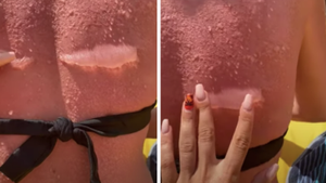 Woman's Horrific Sunburn Reminds Us Why Sun Protection Is Essential