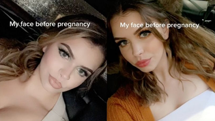 Woman Shares Her Face Before And After Pregnancy