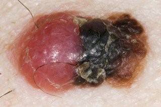 Keep an eye on if a mole is bleeding, itching, crusting or raised (Credit: NHS)