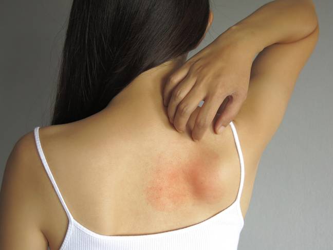 Some people are reporting a prickly heat rash (Credit: Shutterstock)