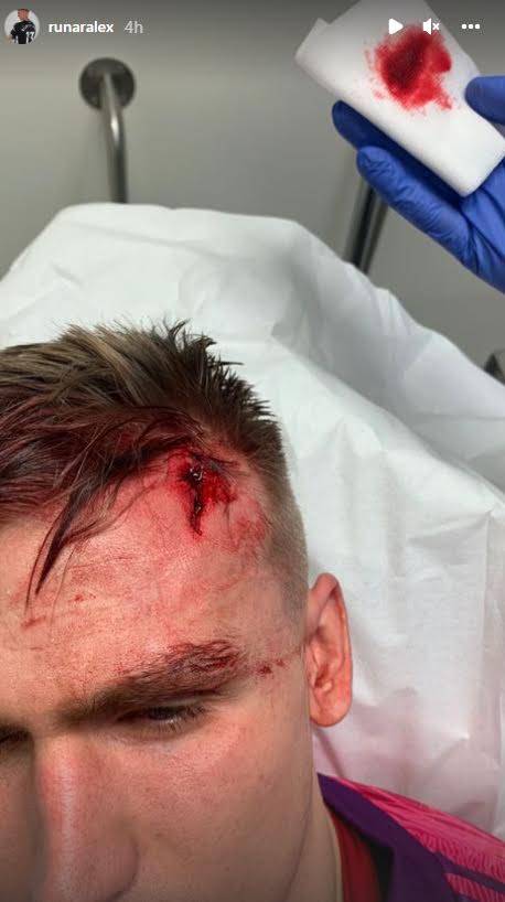 Runarsson shows off his injury. Image: PA Images