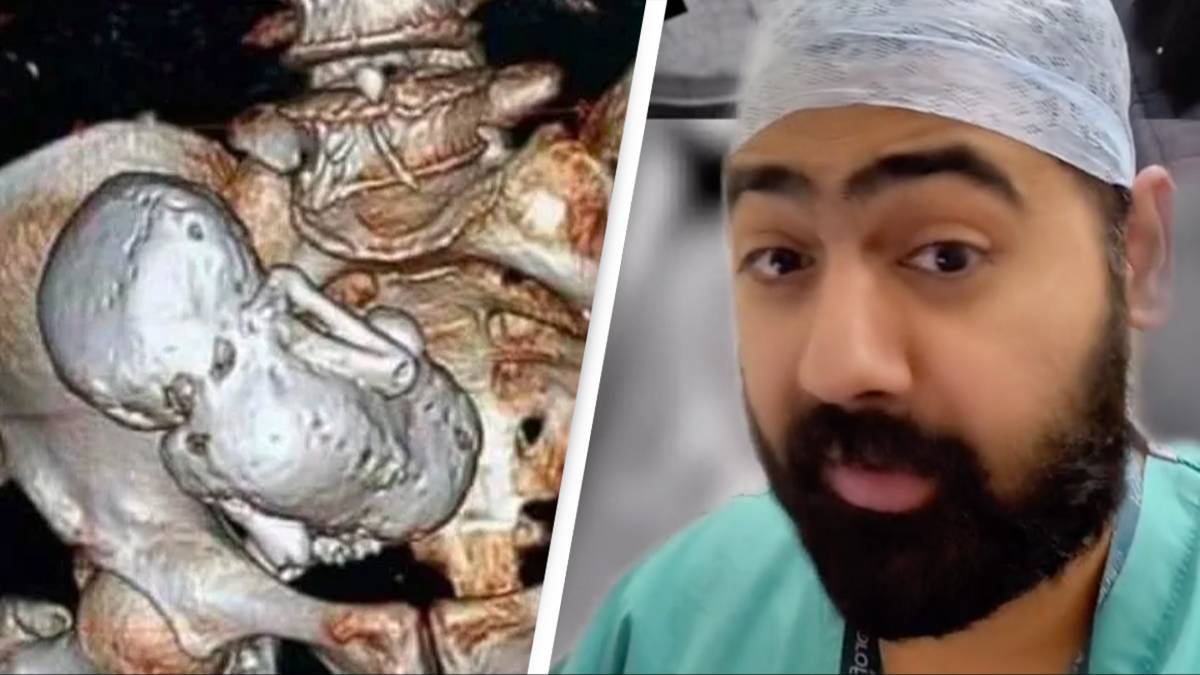 Les médecins découvrent un « bébé de pierre » dans le ventre d’une femme de 73 ans