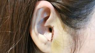 女人在鼻子工作手术期间不知不觉地将她的一部分耳朵移开