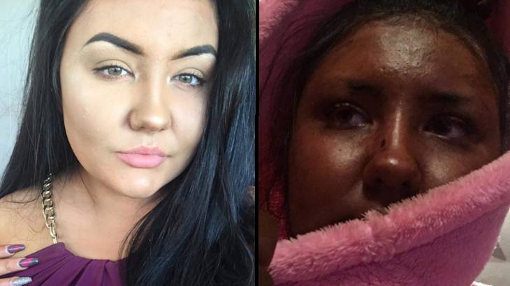 Young girl shares tan disaster after turning green with St. Moriz