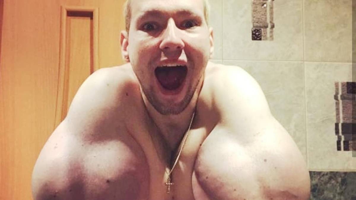 Russian 'Popeye' has 3 pounds of 'dead' muscle removed after DIY  bodybuilding injections