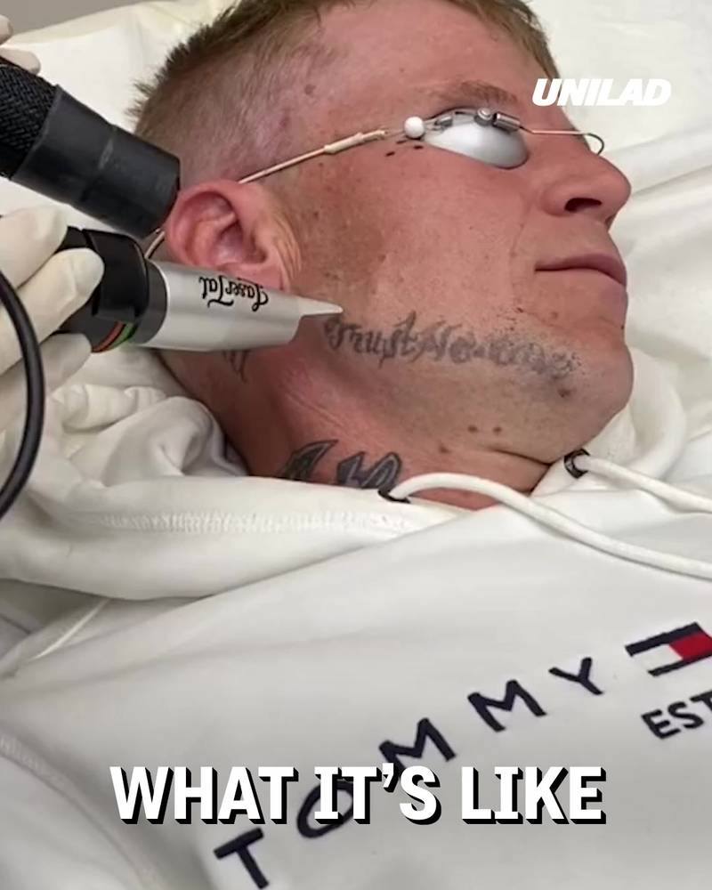 Guy gets tattoo removed from his face 👀