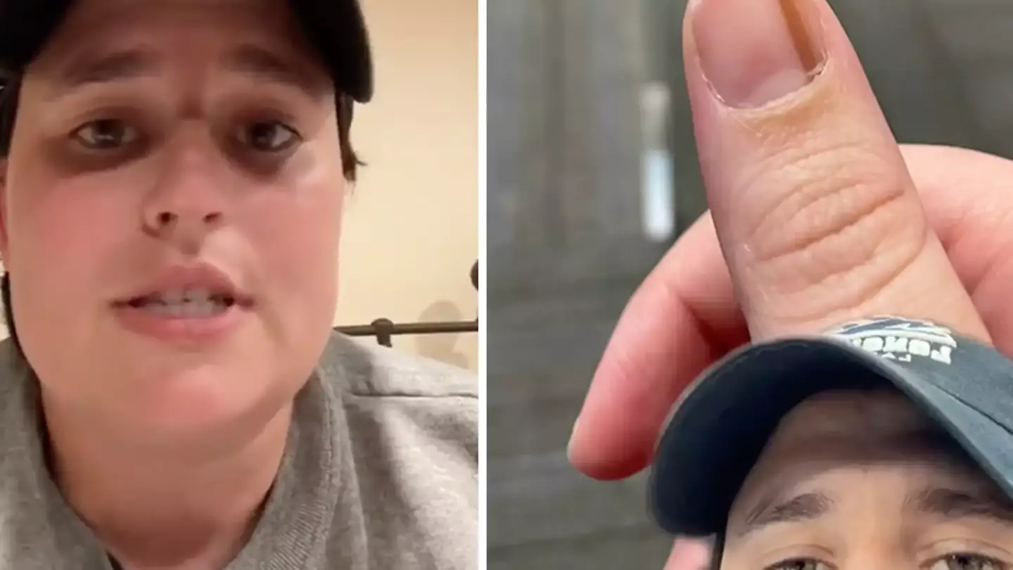 Woman's Warning To Look Out For Brown Line On Your Thumbnail