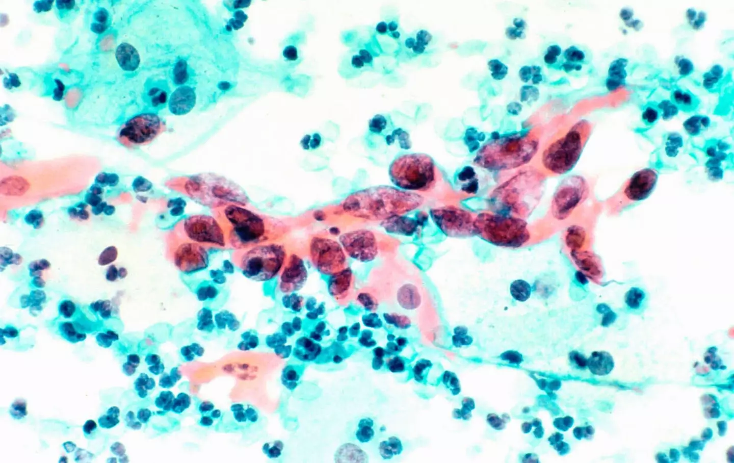 The test could help detect cervical cancer.