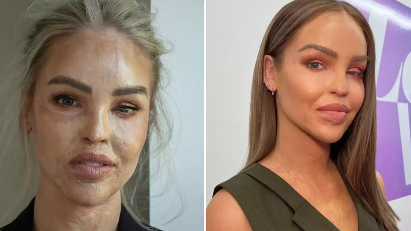 Katie Piper suffers ‘bad infection’ whilst undergoing ‘unexpected’ procedure after eye is sewn shut for a year