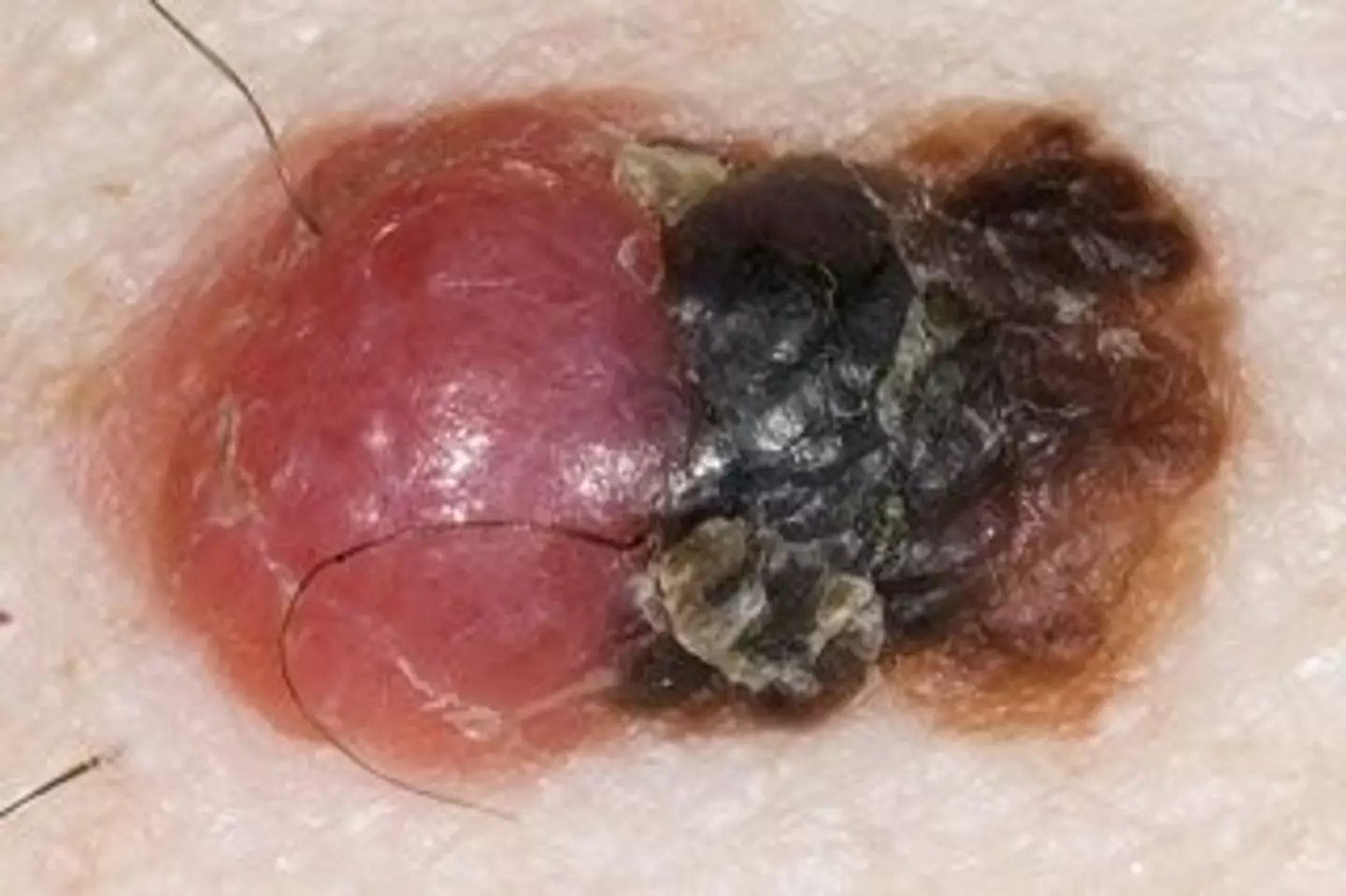 Keep an eye on if a mole is bleeding, itching, crusting or raised (