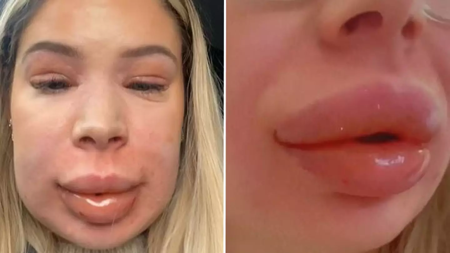 Woman’s horror lip filler reaction left her 'thinking she would die' as face doubled in size