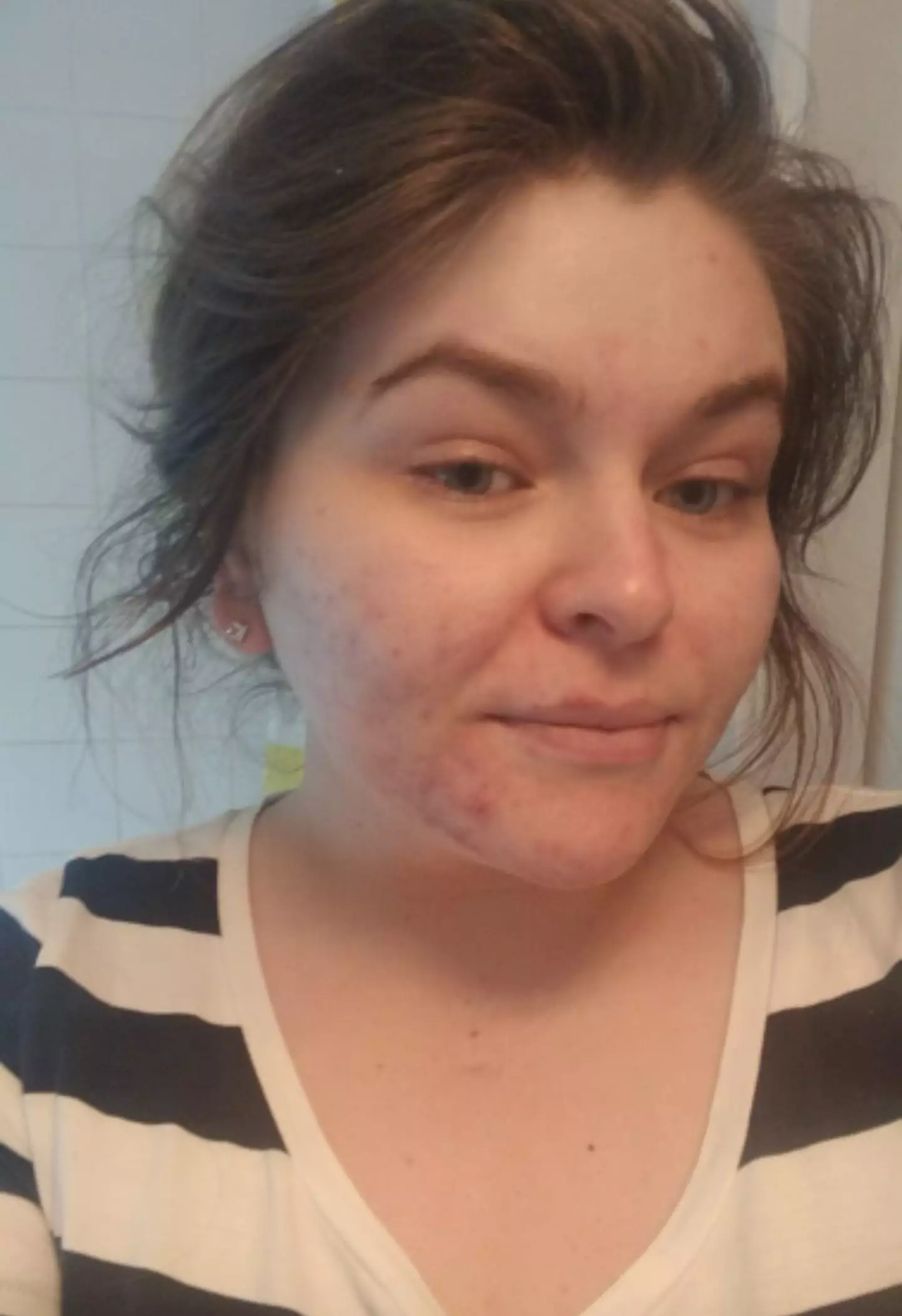 Her skin left her too self-conscious to leave the house without makeup.