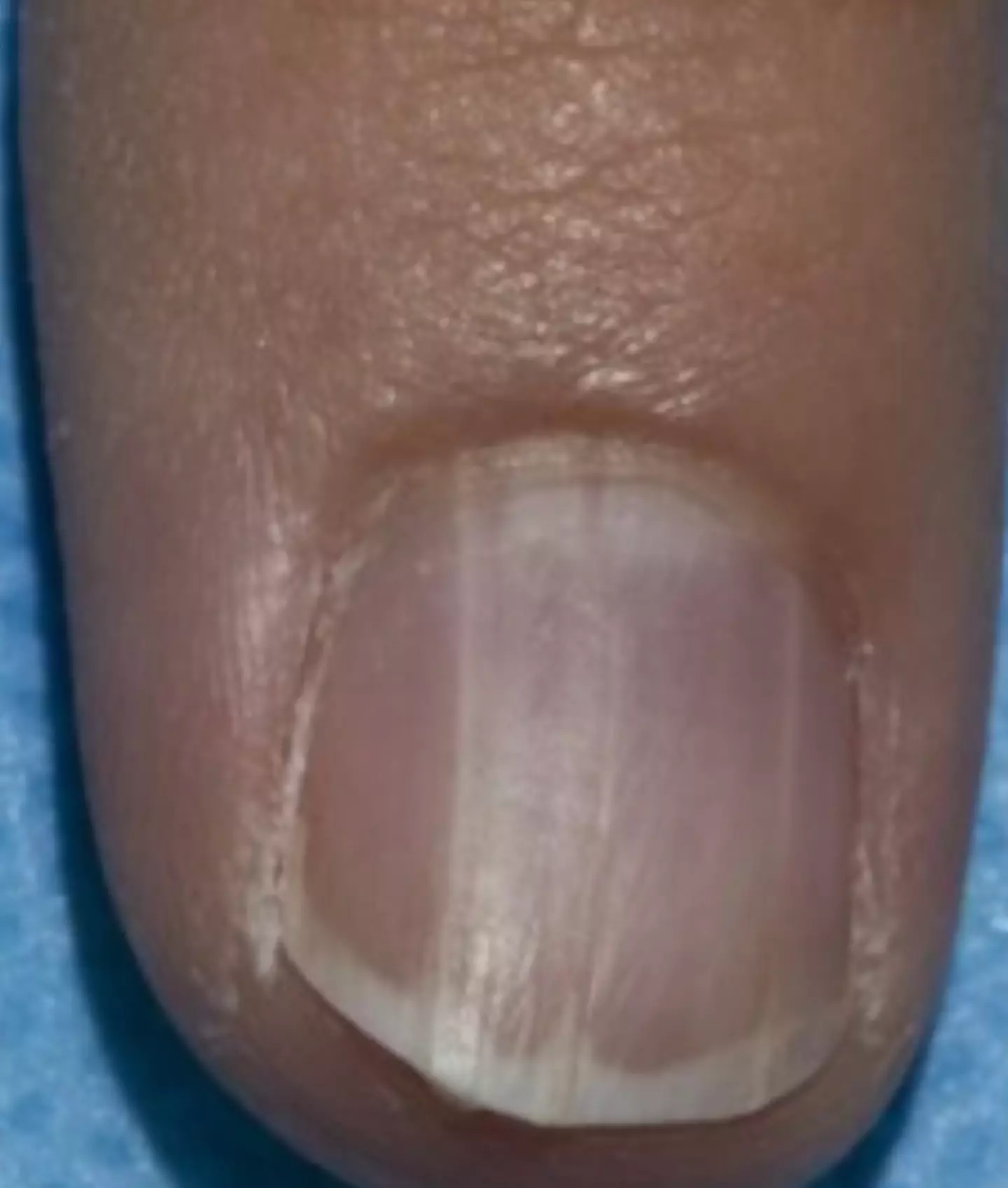 The condition is only likely to affect one nail. (Dermatology Consultation Service)