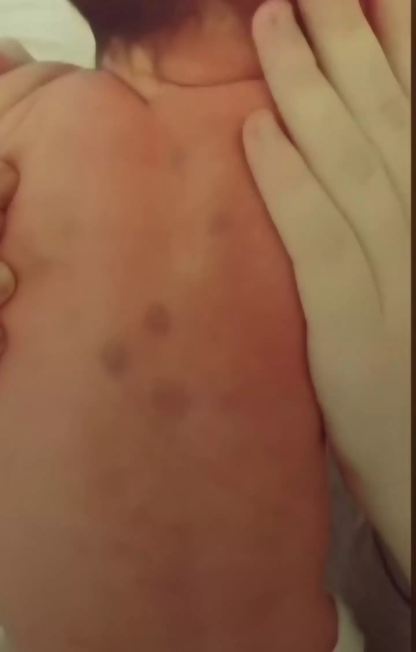 Amelia was born with purple spots across her body. (SWNS)