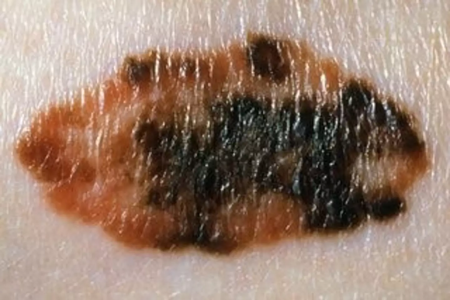 Look out for a mole that has changed colour or has more than two colours to it (