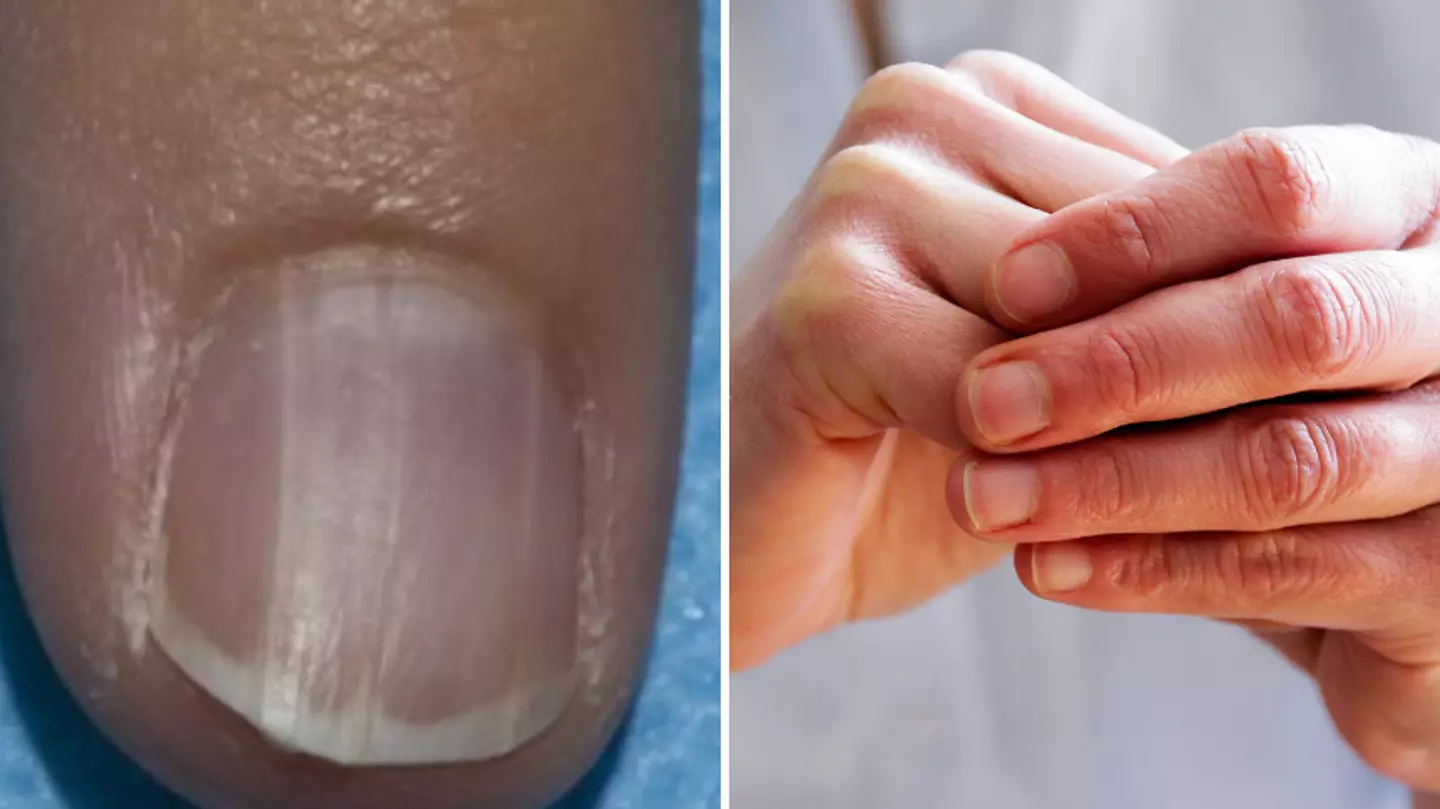 Experts issue warning about 'nail abnormality' linked to cancer