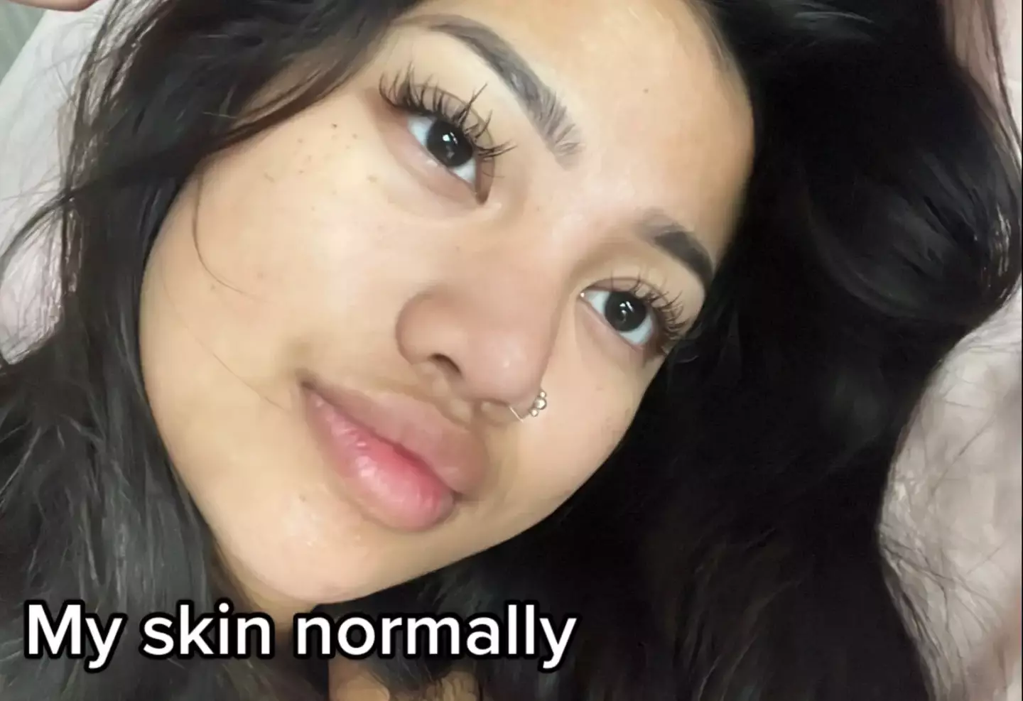 Louaira Dela Cruz's skin before she contracted ringworm.