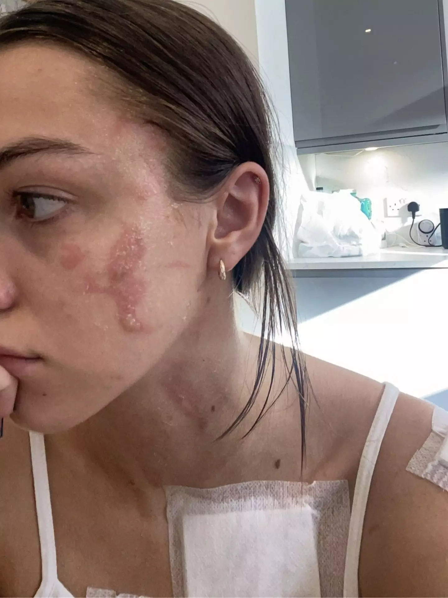 She suffered second degree burns. (Kennedy News and Media)