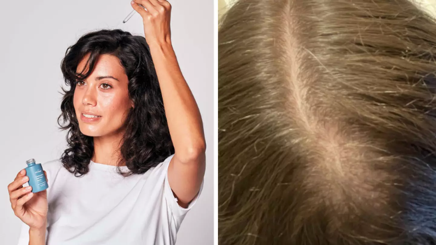 Women see results in ‘weeks’ of using hair regrowth serum and the photos are unbelievable