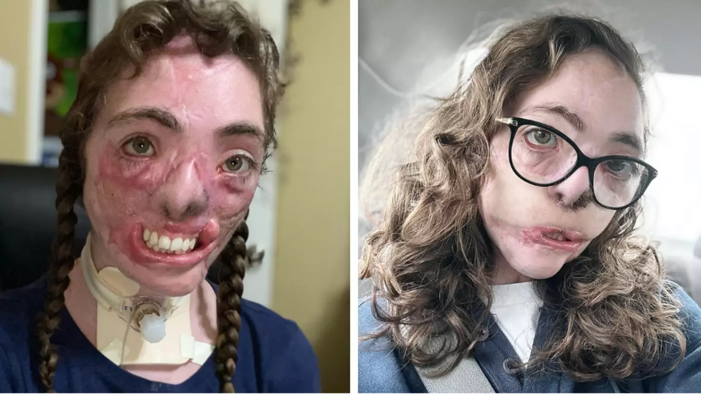 Woman who had face torn off by two dogs shares latest reconstructive surgery results