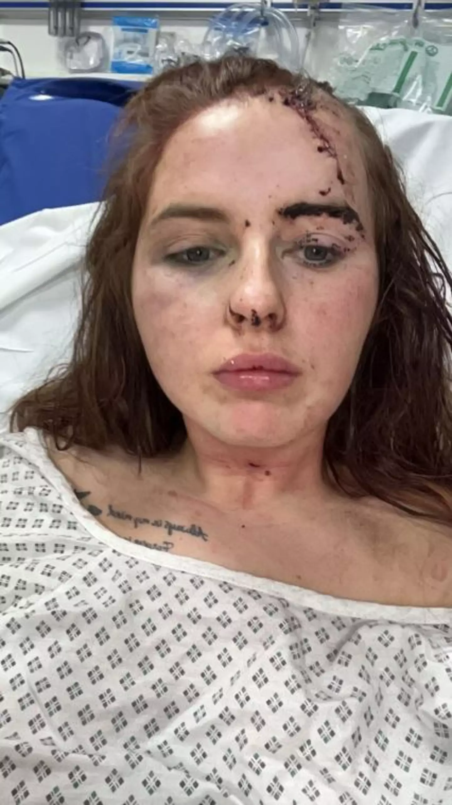 Emily Lewis woke up in hospital with horrific injuries last February (WalesOnline/Media Wales)