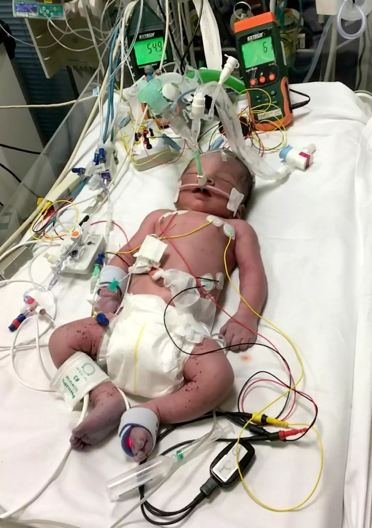 Shanto spent the first few weeks of his life on a ventilator.