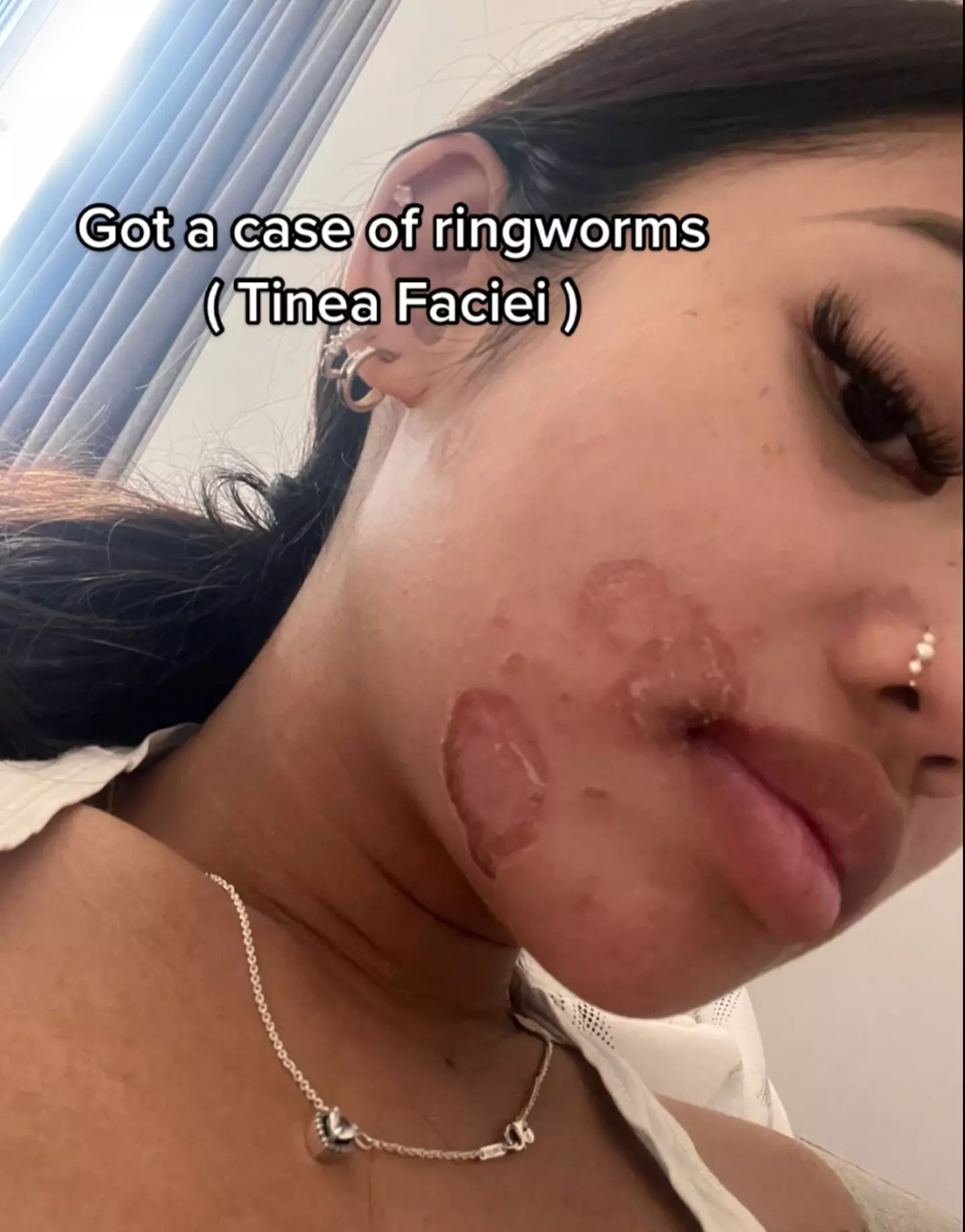 Louiaira Dela Cruz developed ringworm after sharing her makeup brushes.
