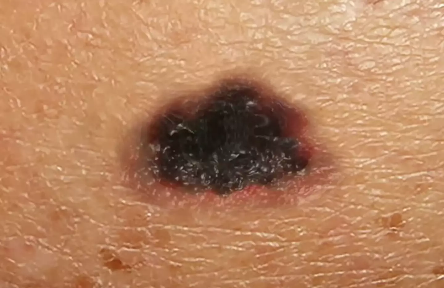 The clip showed a time-lapse from normal to Stage 4 melanoma over 10 years. (YouTube/@fauquierent)