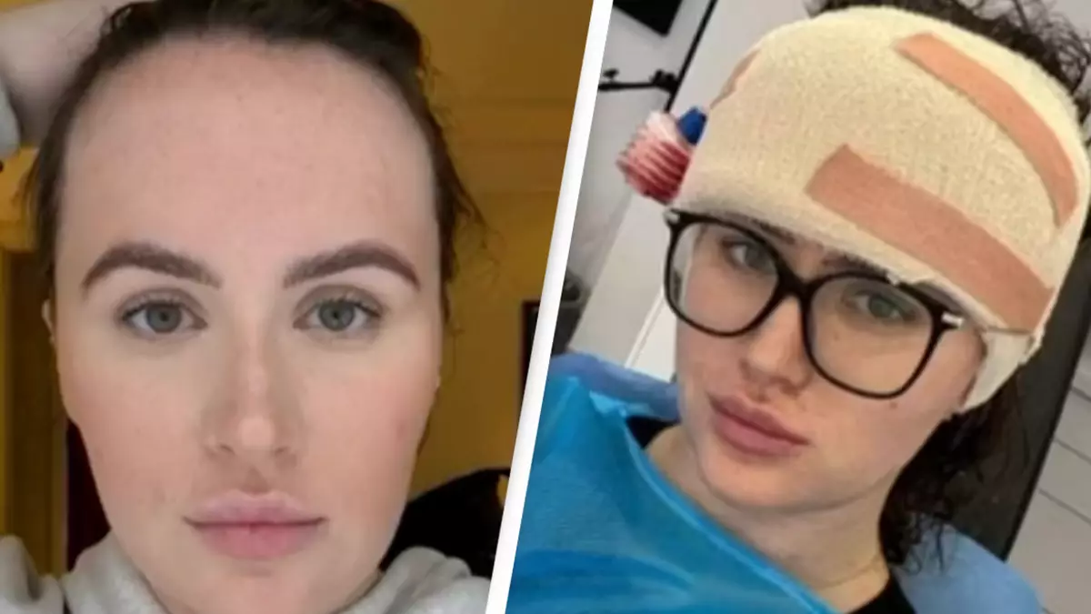 Woman showcases the results of 'life-changing' $11,000 surgery to make her forehead smaller