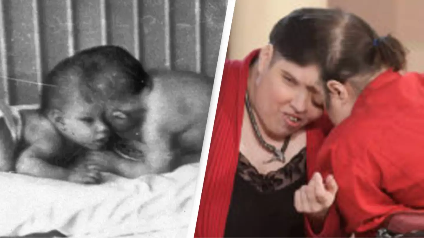 World's oldest conjoined twins George and Lori have died aged 62
