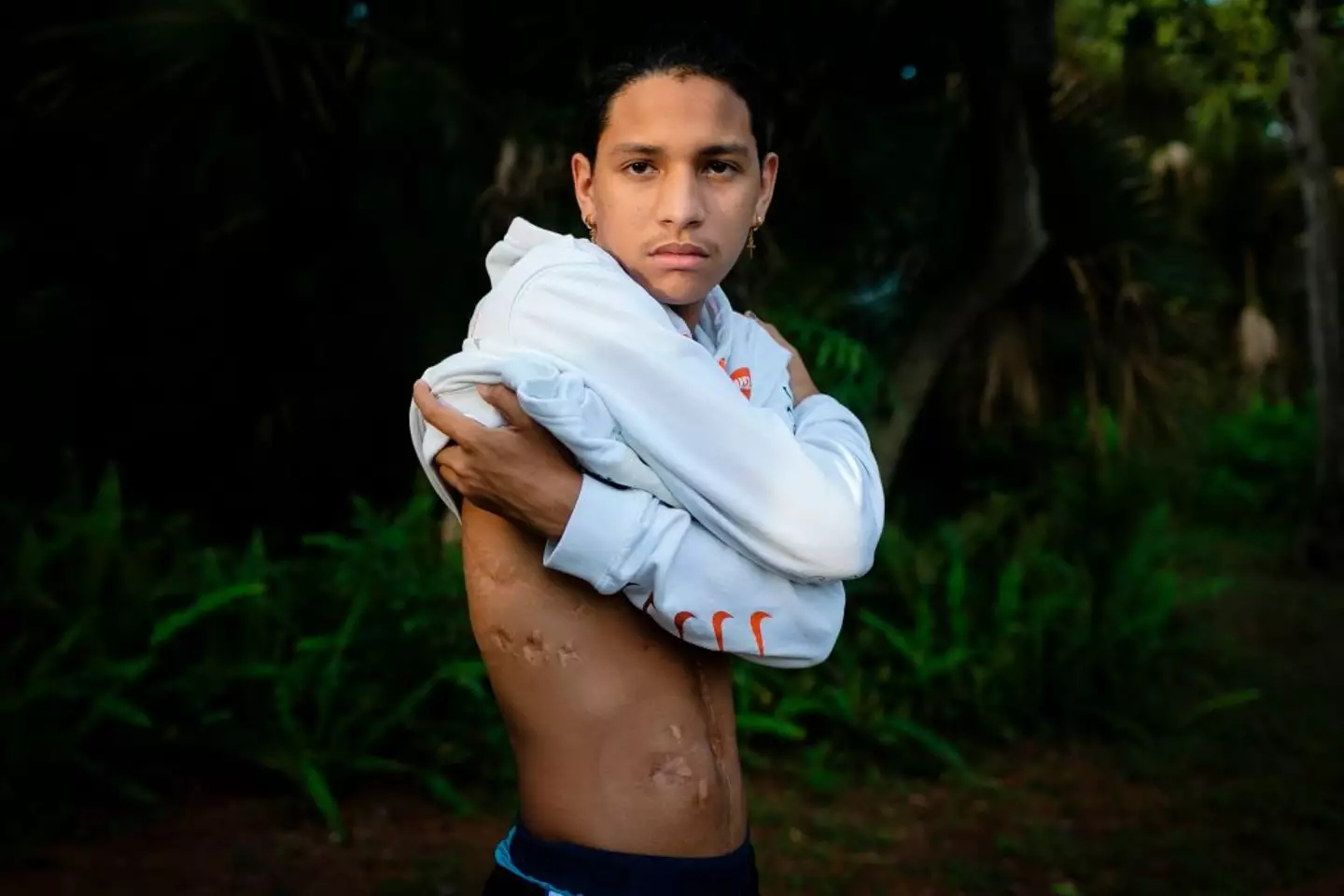 Anthony Borges shows his injuries a year on from the massacre. (EVA MARIE UZCATEGUI/AFP via Getty Images)